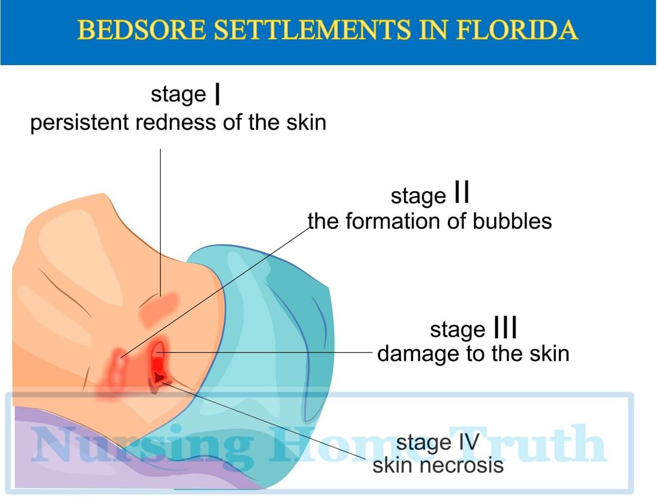 Florida bed sore Settlements 