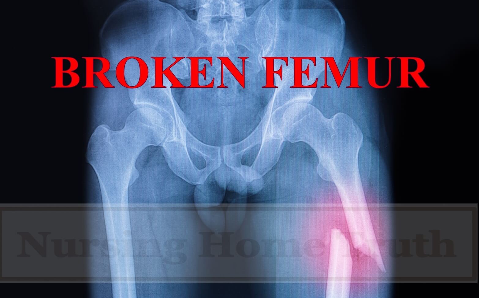 Broken Femur