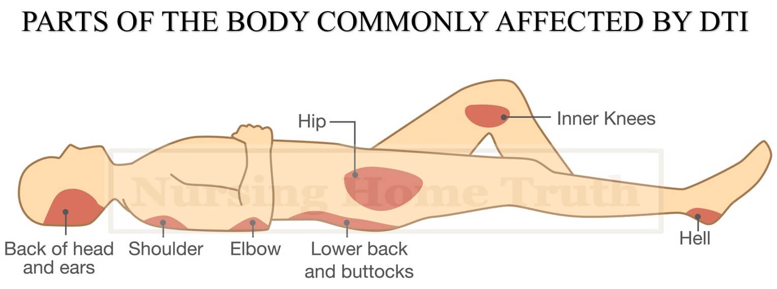 DTI Common Body Parts Affected