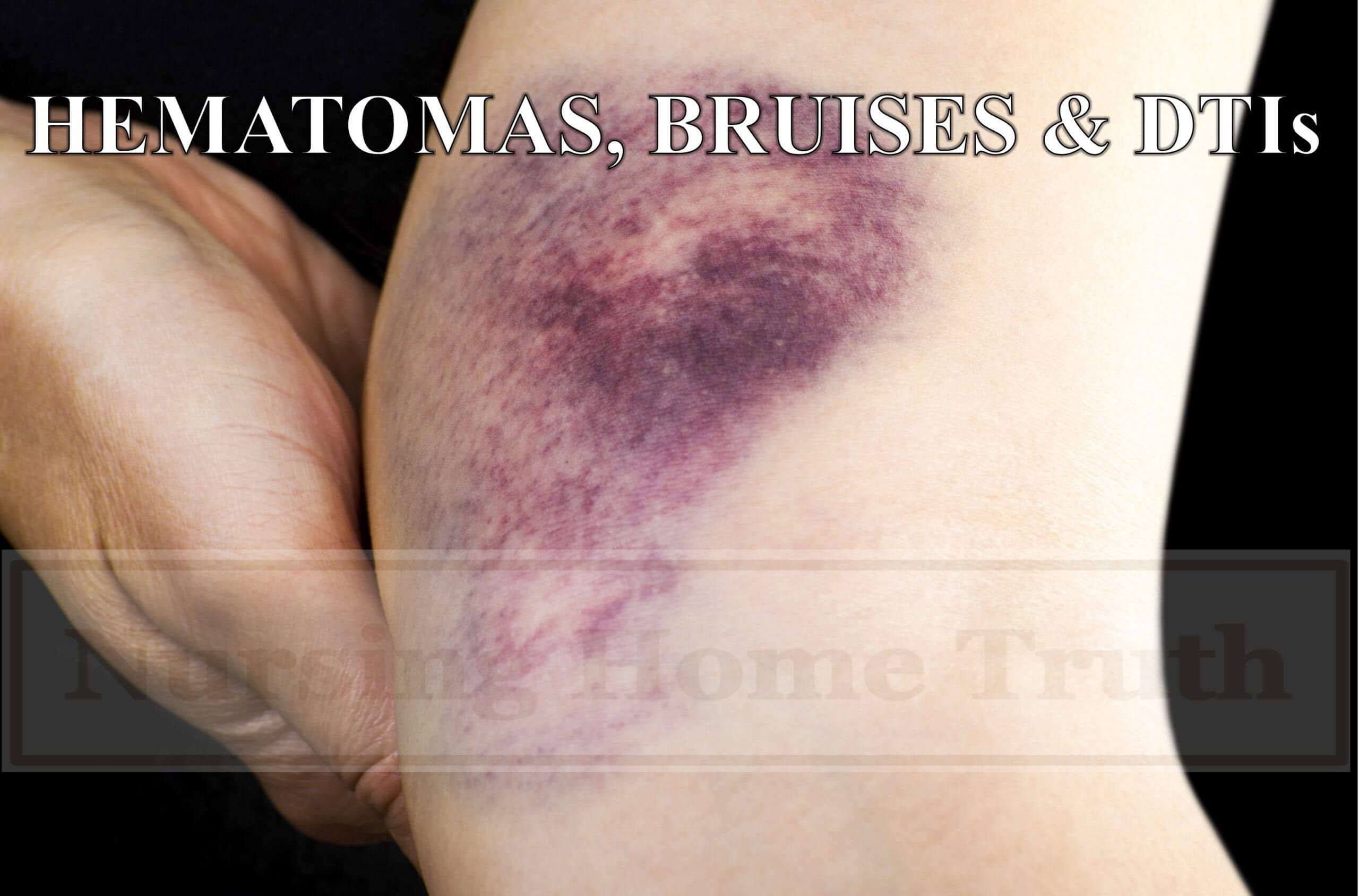 DTIs, Hematomas, Bruises