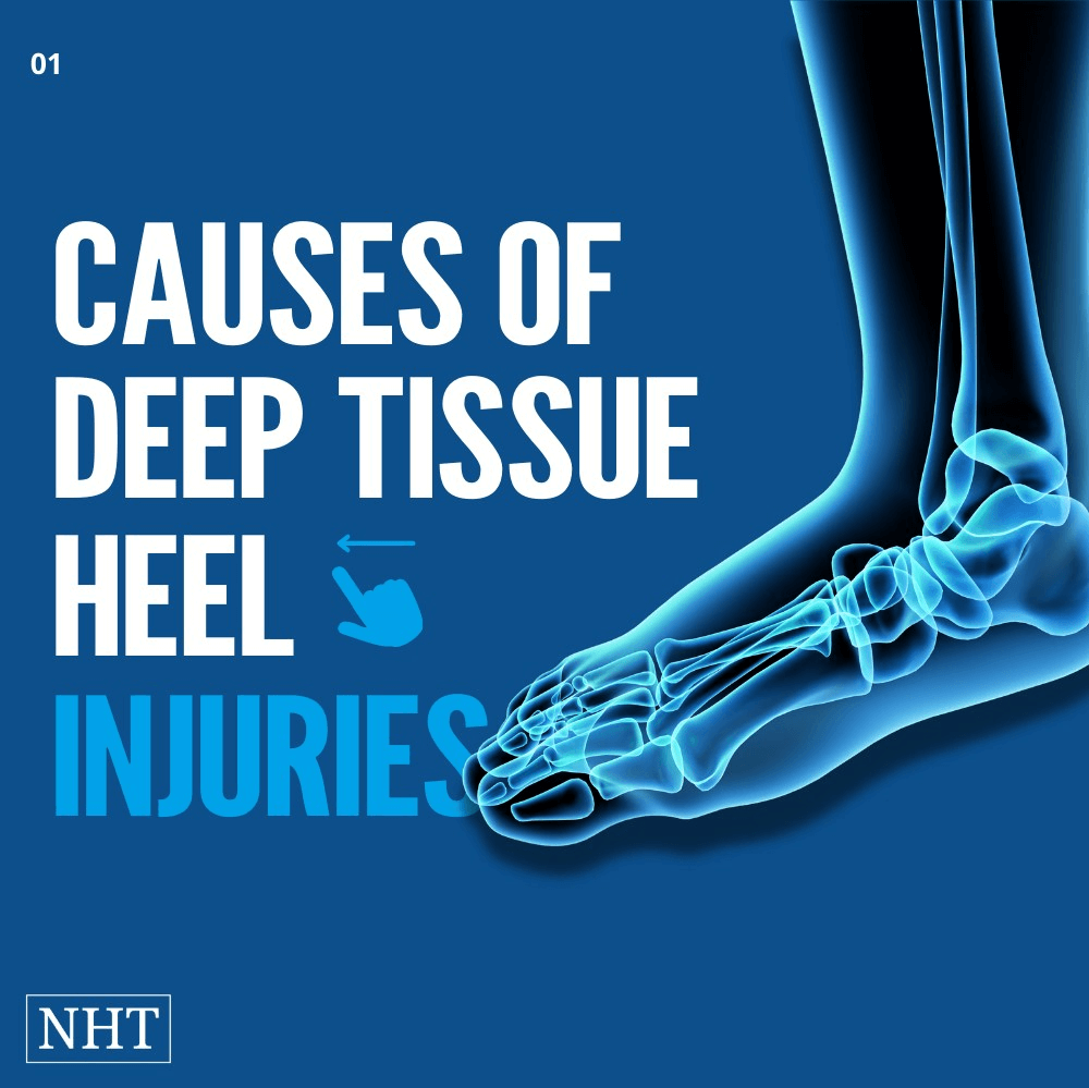 Deep Tissue Injury Heel