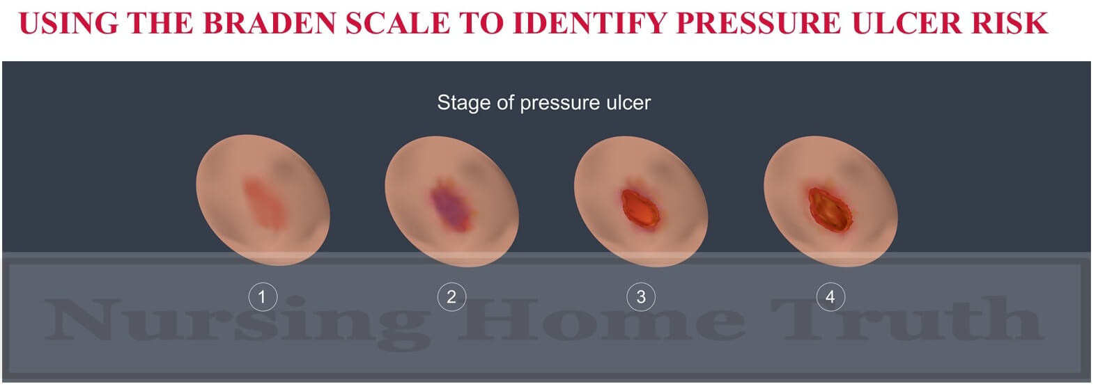 Braden Scale For Pressure Ulcers