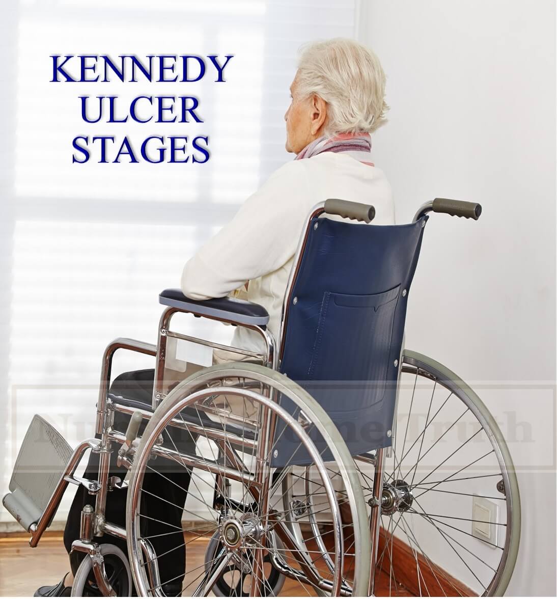 Kennedy Ulcer Stages