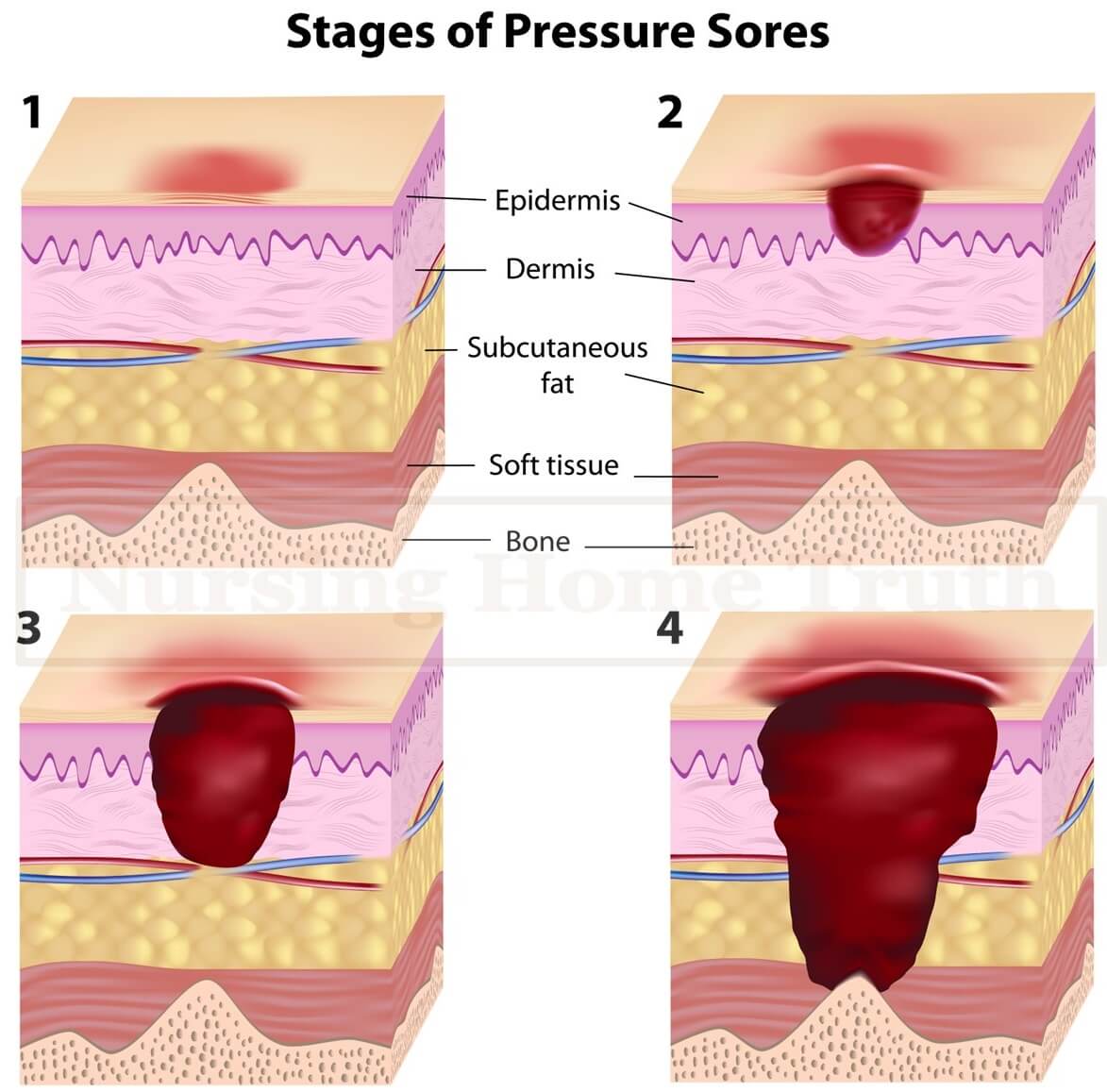 Pressure Sore Stages And Bed Sore Death