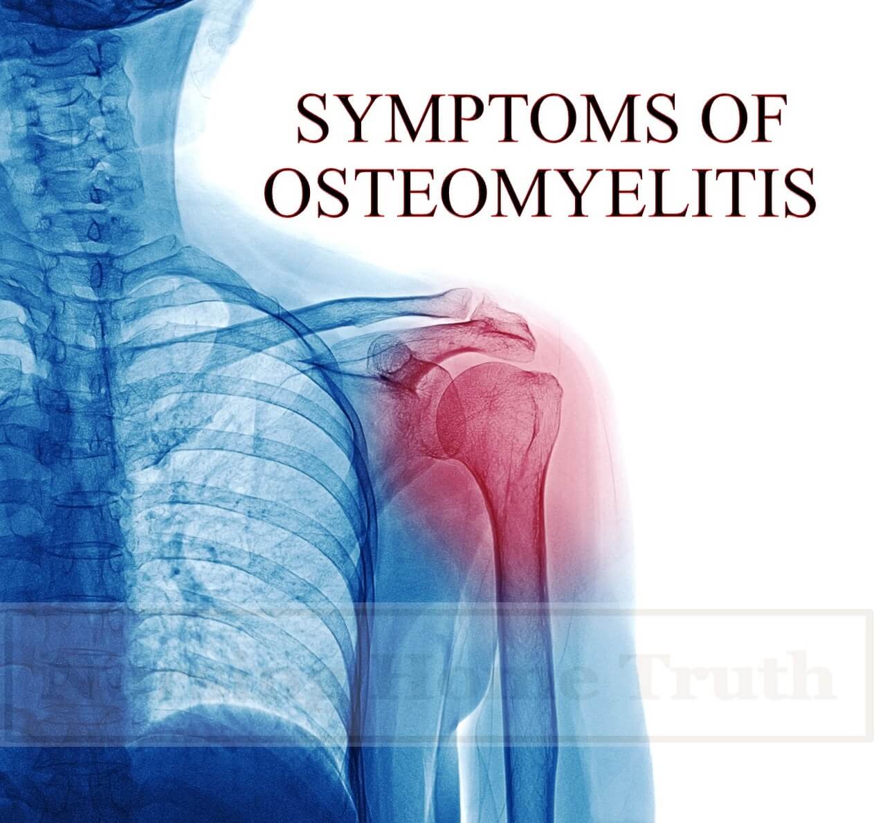 Symptoms of Osteomyelitis