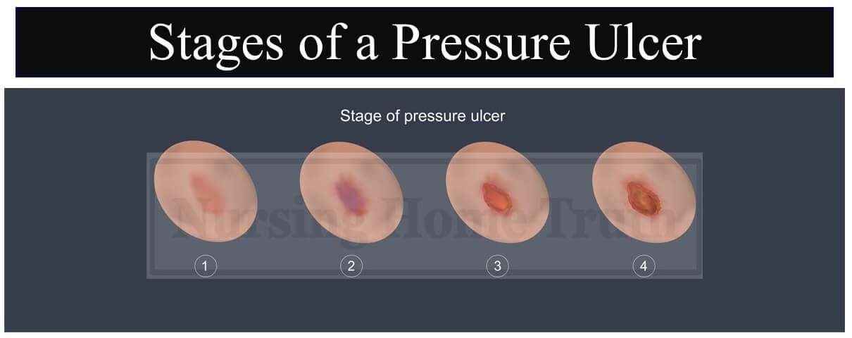 Stages of a pressure ulcer